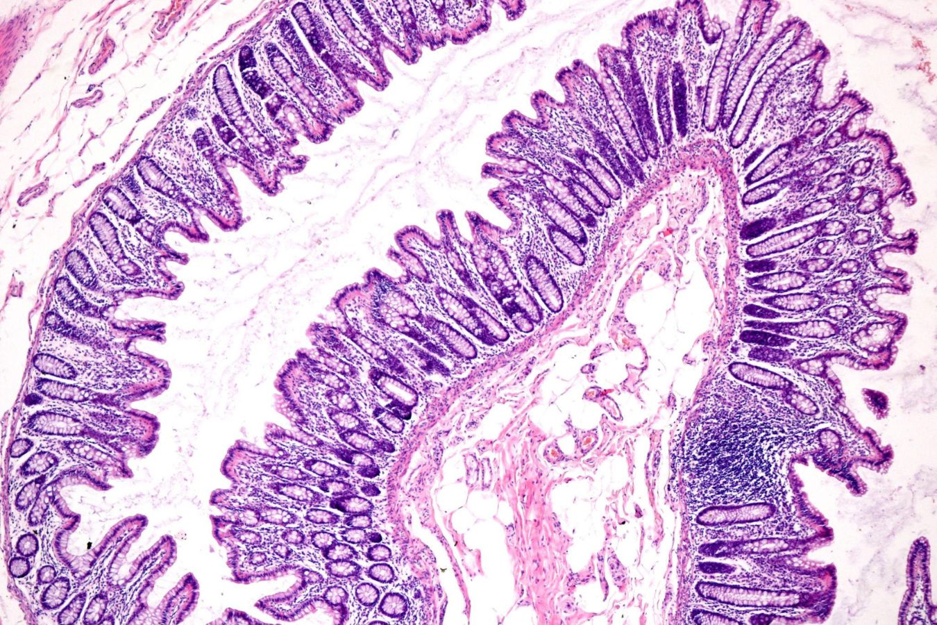 Microscopic Colitis: What Your Biopsies Really Show (From an NHS Lab Scientist)